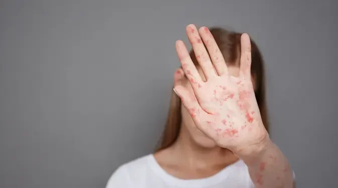Pernah Terkena Campak, Risiko Terinfeksi Kembali Sangat Rendah